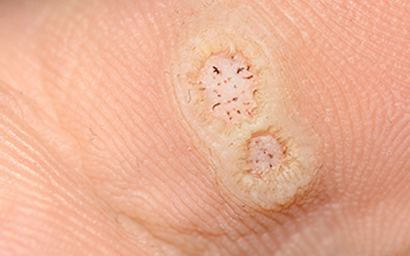 What are Plantar Warts?